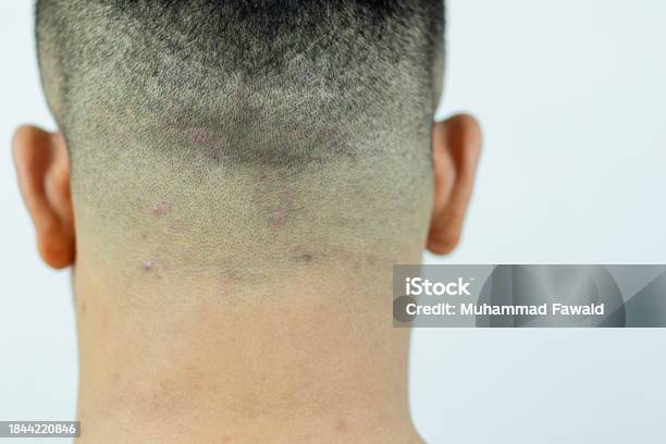 dermatitis seboroik di kepala