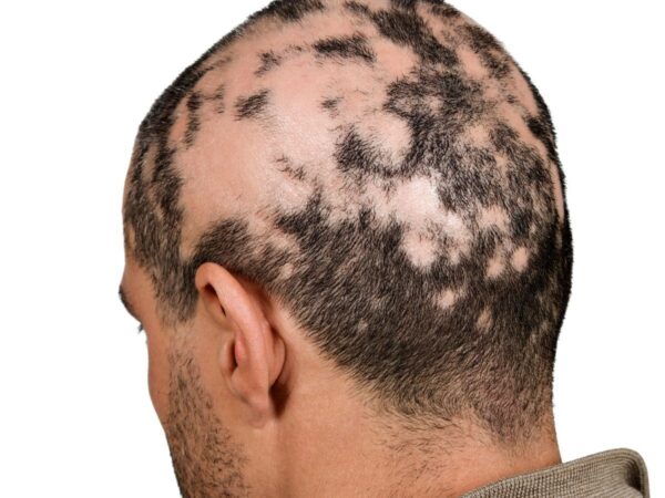 autoimun alopecia areata