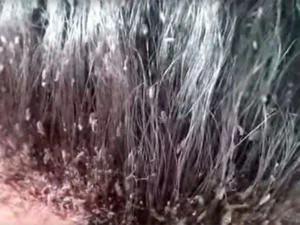 cara menghilangkan kutu rambut