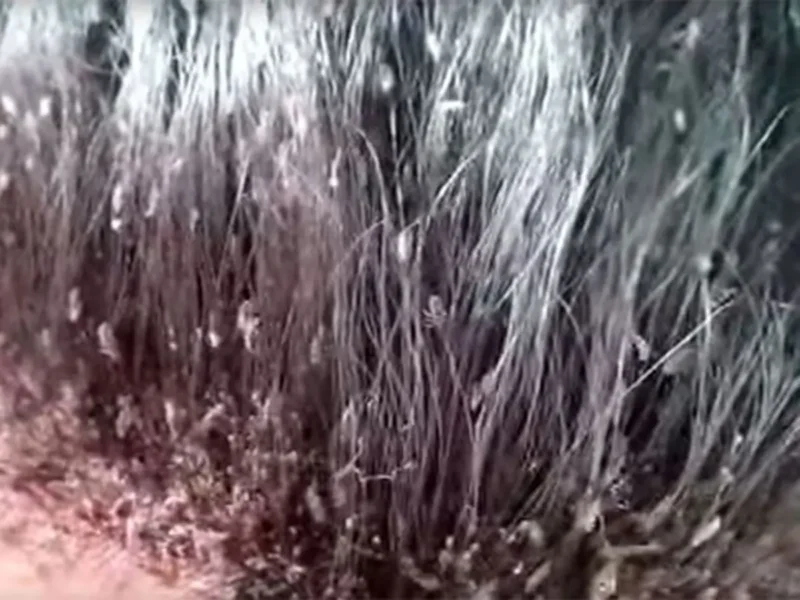 cara menghilangkan kutu rambut