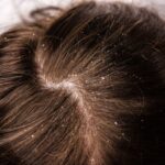 kulit kepala gatal bisa bikin rambut rontok