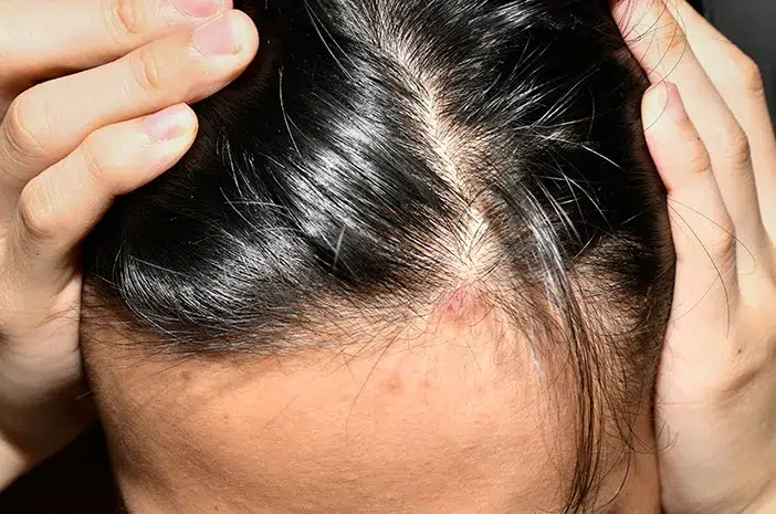 rambut rontok parah pada wanita