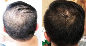 rambut rontok tumbuh kembali