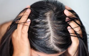 rambut berminyak dan lepek