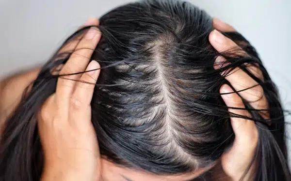 mengatasi rambut berminyak dan lepek