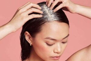 vitamin untuk rambut rontok parah