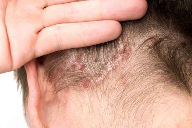tanda penyakit dermatitis seboroik