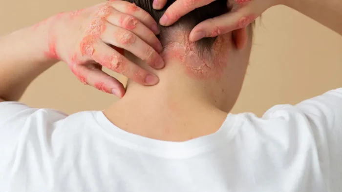 penyakit psoriasis kepala