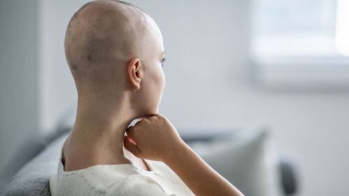 rambut habis akibat kemoterapi