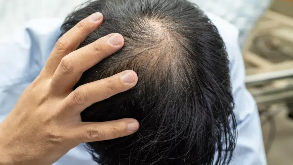 contoh rambut rontok berlebihan yang perlu Anda perhatikan