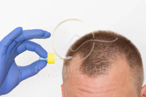 mengoleskan obat minoxidil ke rambut